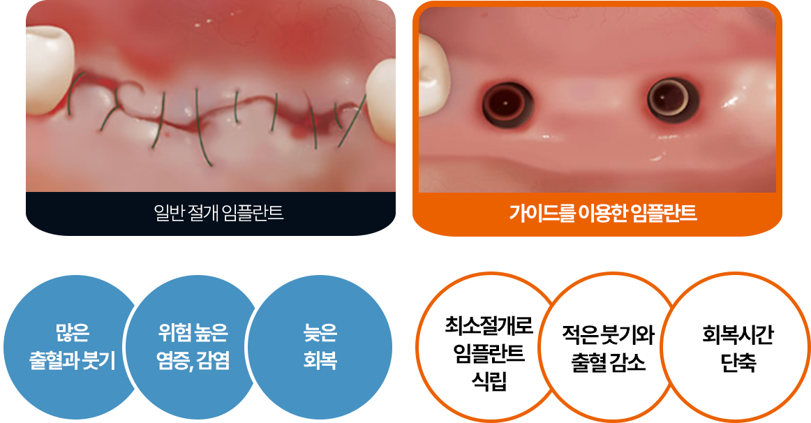 일반 절개와 가이드 임플란트의 시술 및 회복 과정 비교